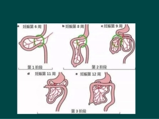 医学课件先天性肠旋转不良的临床特点及各种影像诊断方式价值探讨