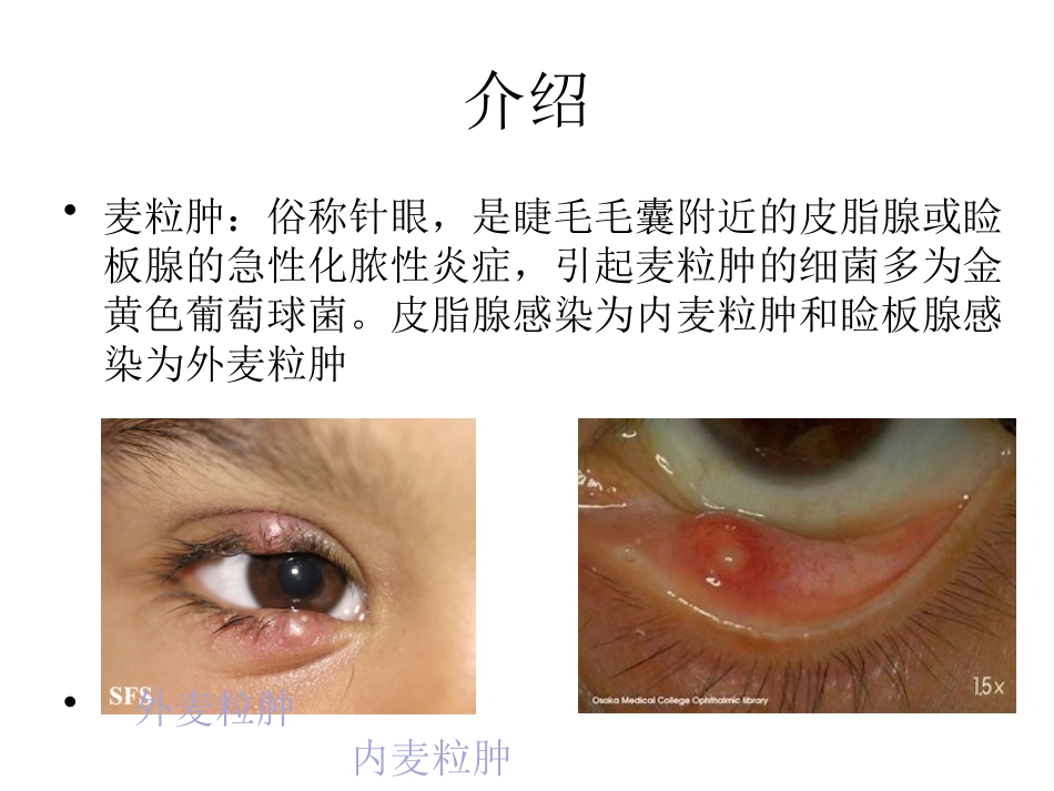 医学麦粒肿手术专题知识宣教课件_第2页