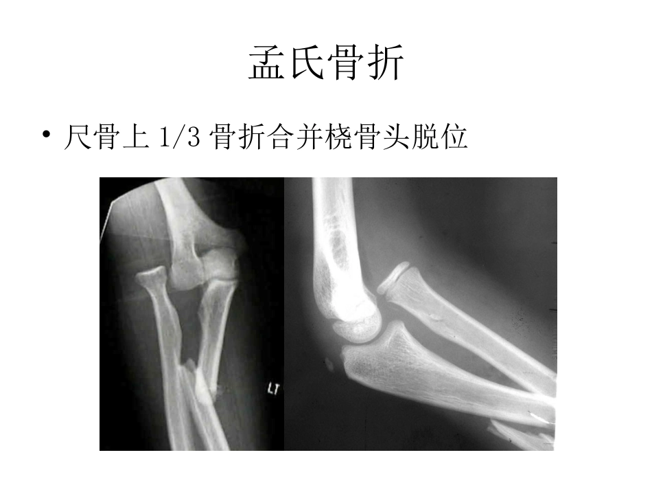 医学孟氏骨折和盖氏骨折的分类和治疗_第2页