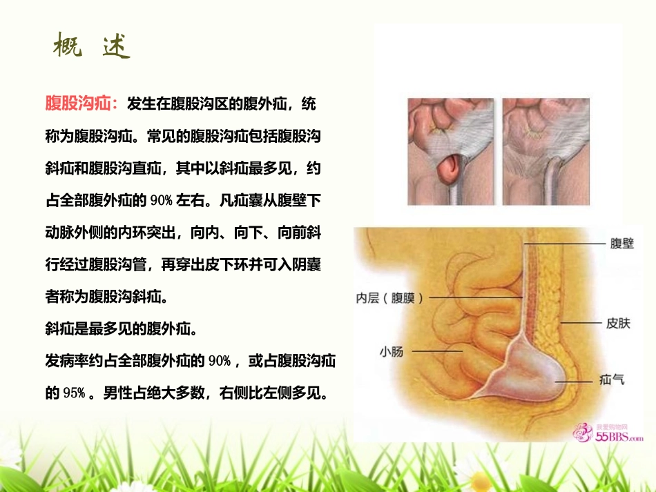 右腹股沟斜疝_第3页