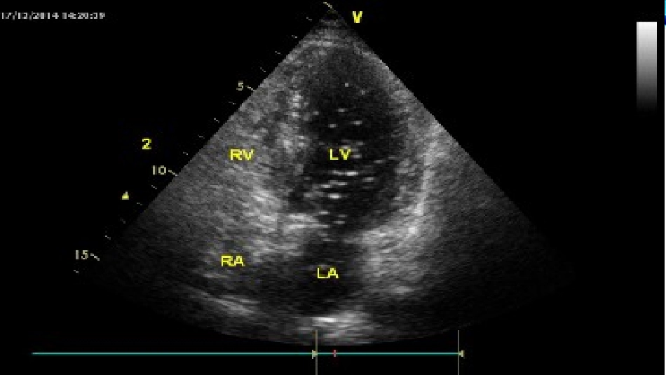 右心声学造影_第3页