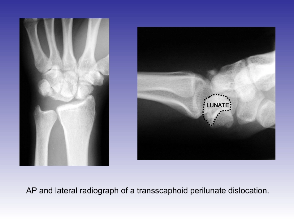 月骨脱位手术图解_第2页