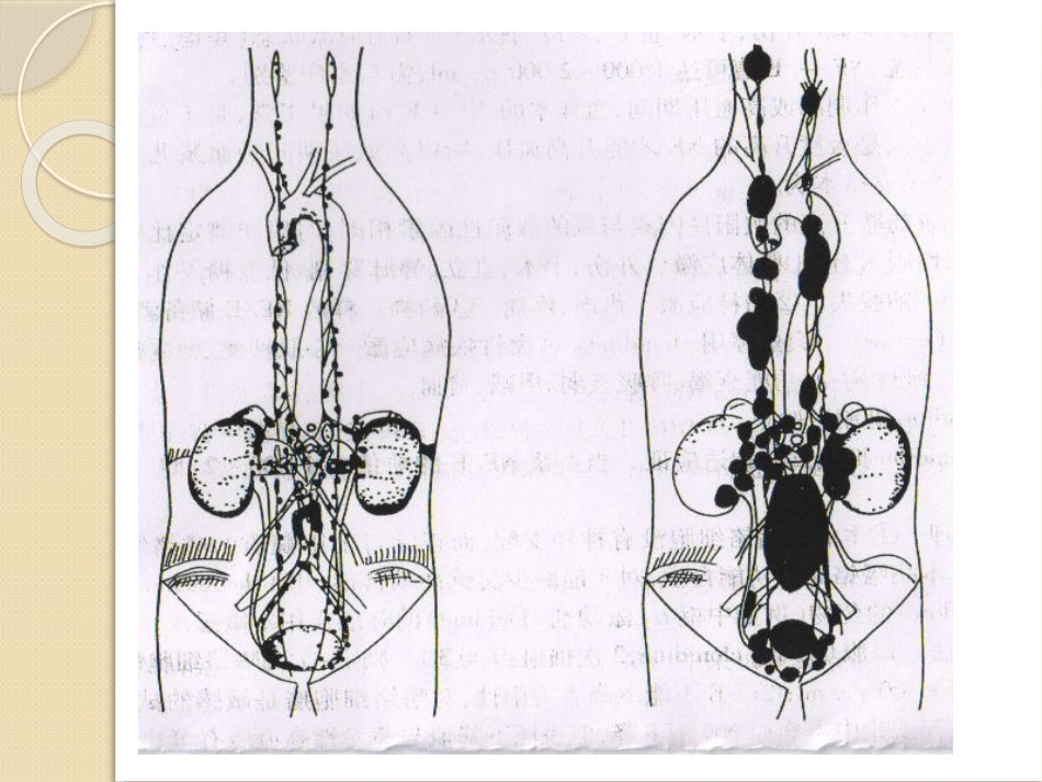 张文举嗜铬细胞瘤及副神经节瘤的诊断与治疗_第3页