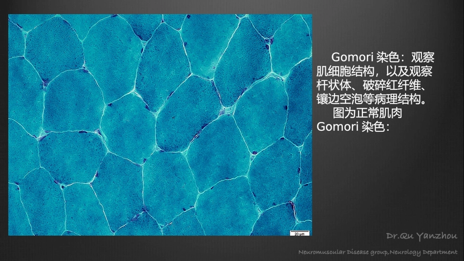 正常肌肉及常见肌病的病理学表现_第3页