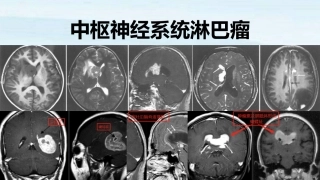 中枢神经系统淋巴瘤概述及影像学特点诊治流程最新