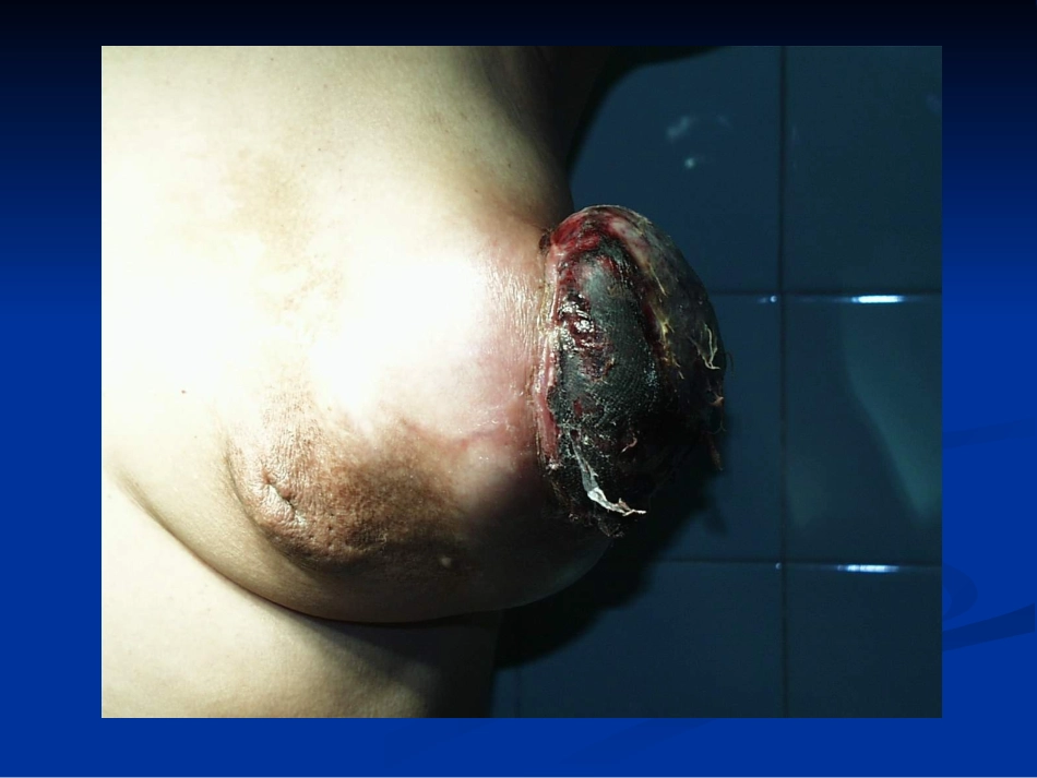 中医外科学乳岩_第2页