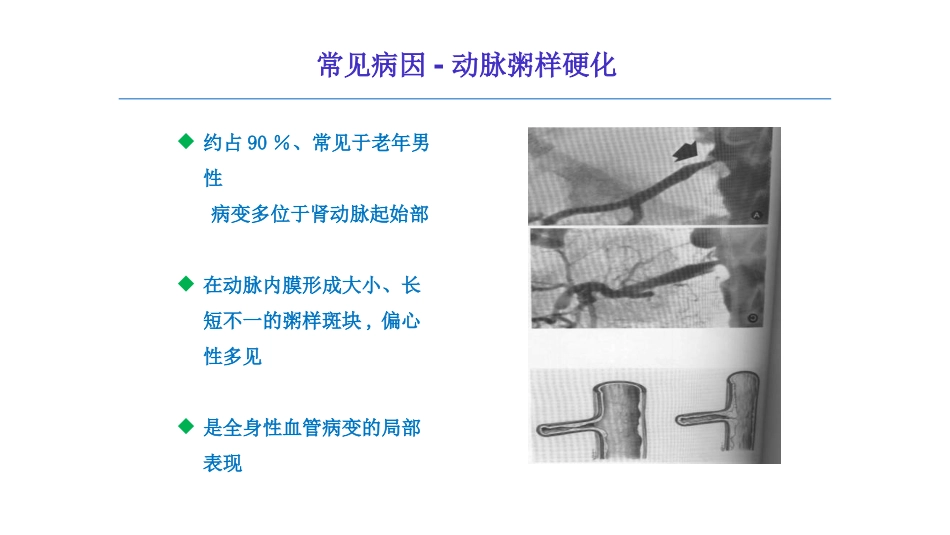 粥样硬化性肾动脉狭窄介入适应症的探讨_第3页
