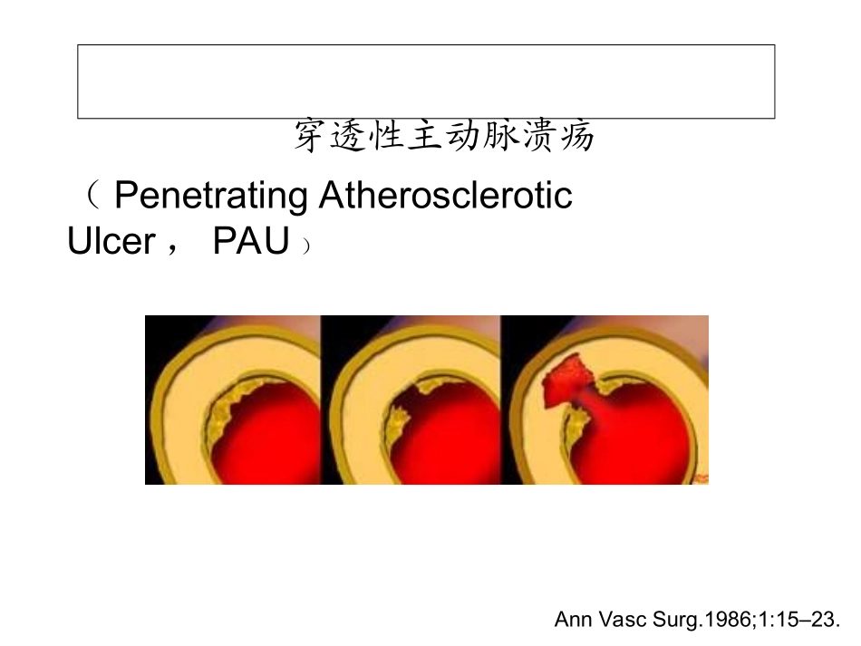 主动脉穿透溃疡的外科治疗_第2页