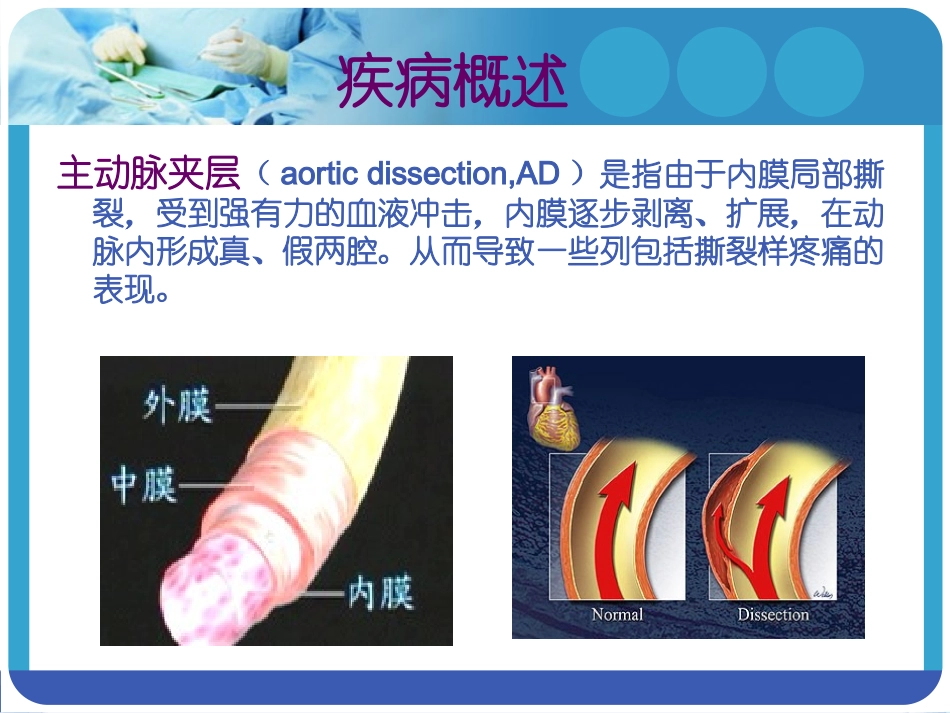 主动脉夹层腔内隔绝术术后患者的护理_第3页