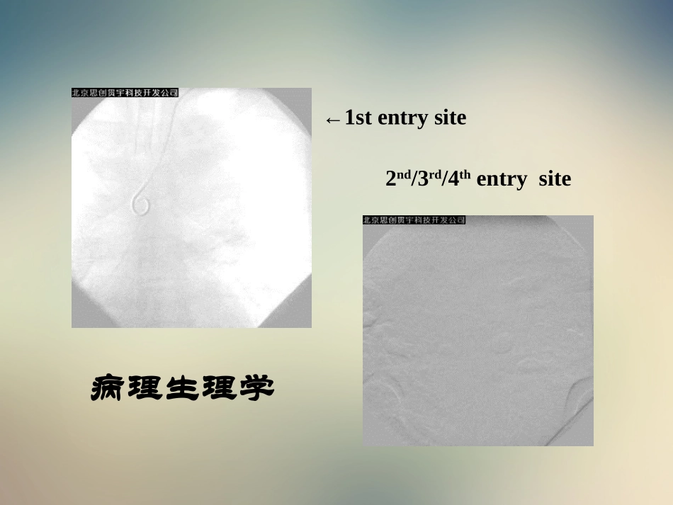 主动脉夹层腔内修复技术适应症与基本技术郭伟_第2页