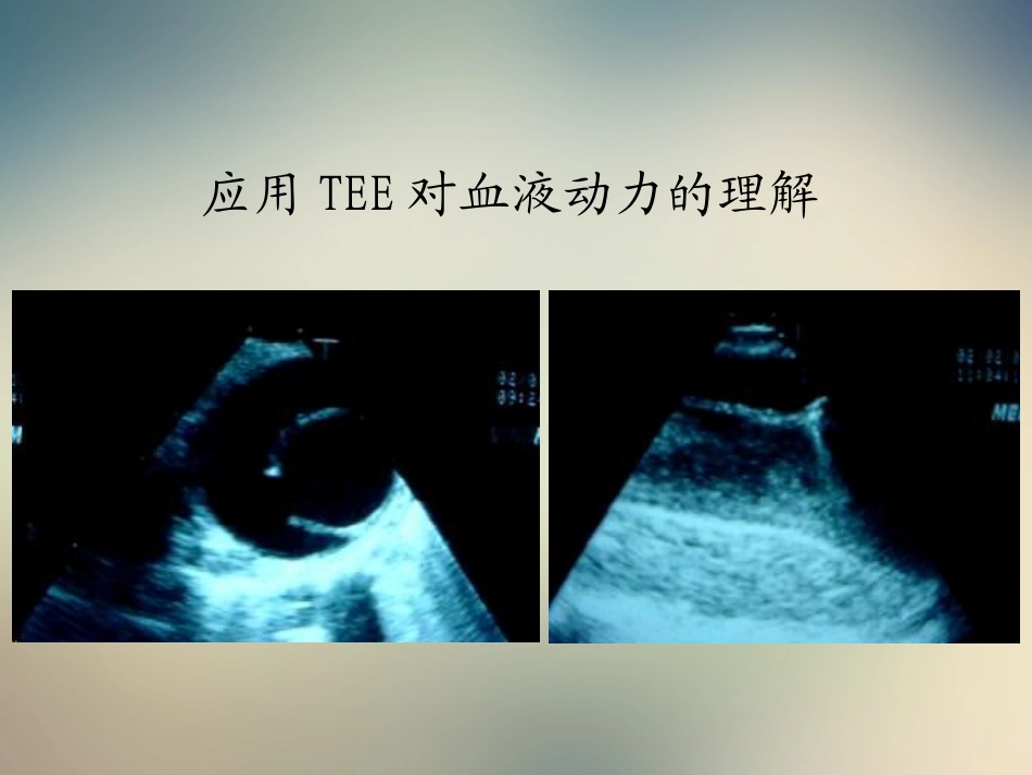 主动脉夹层腔内修复技术适应症与基本技术郭伟_第3页