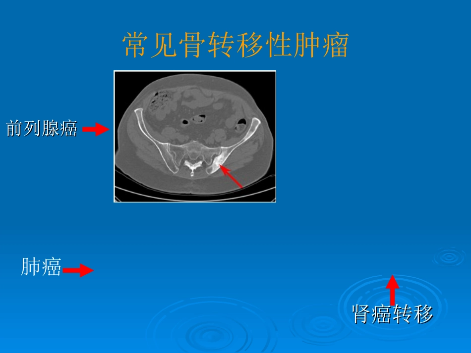 转移性骨肿瘤_第2页