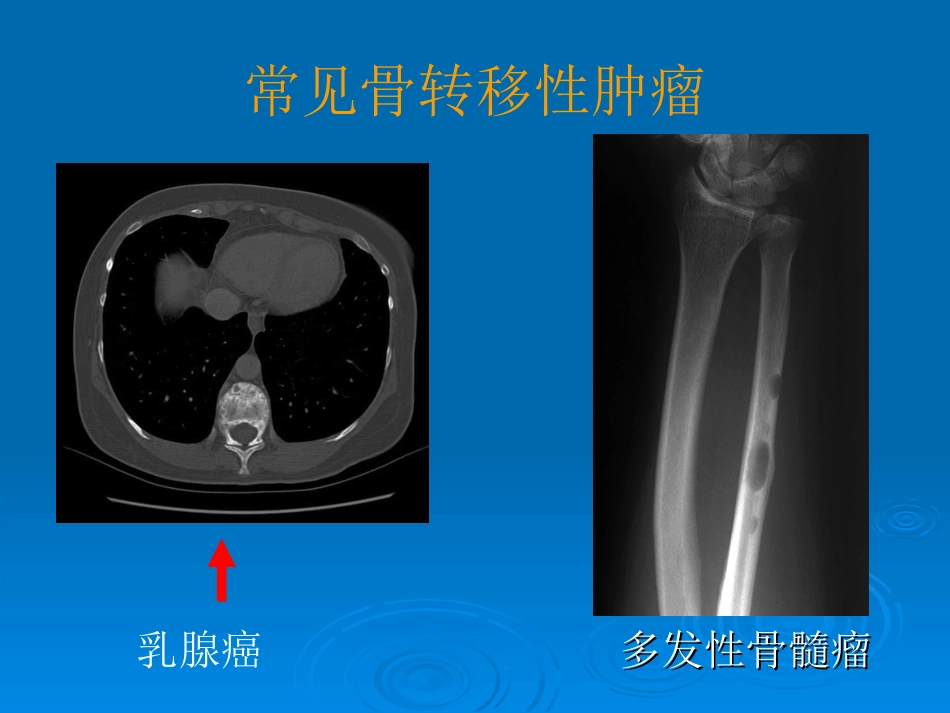 转移性骨肿瘤_第3页