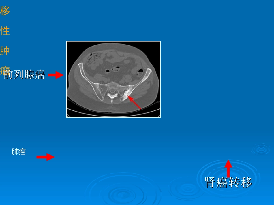 转移性骨肿瘤课件_第2页