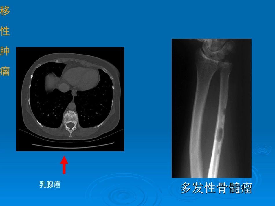 转移性骨肿瘤课件_第3页