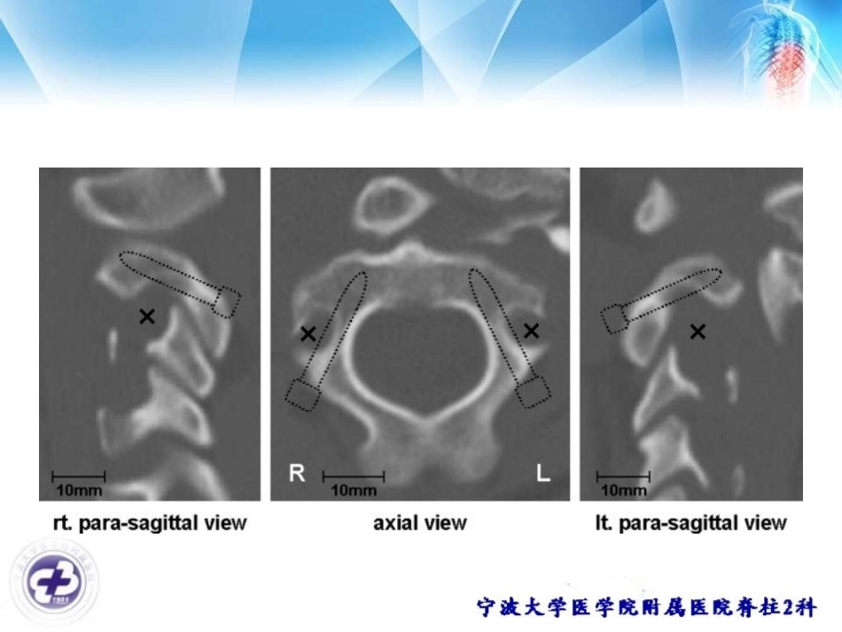椎动脉高跨和颈椎板螺钉_第3页