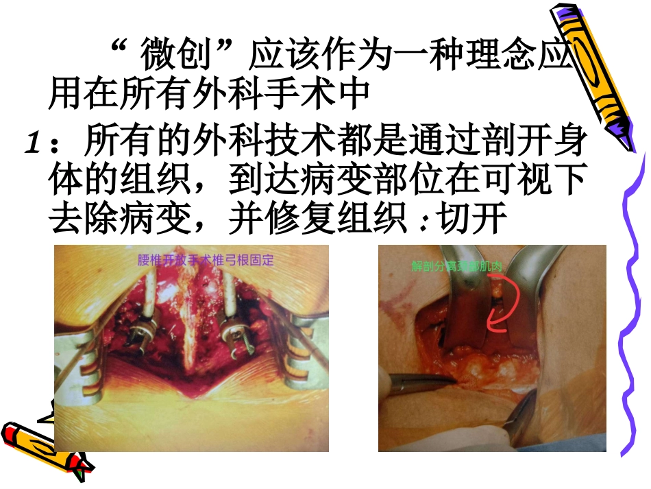 椎间孔镜治疗椎间盘突出_第2页