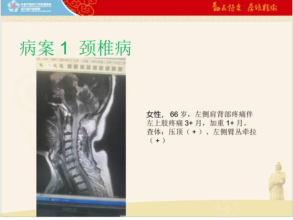 椎旁神经阻滞_第3页