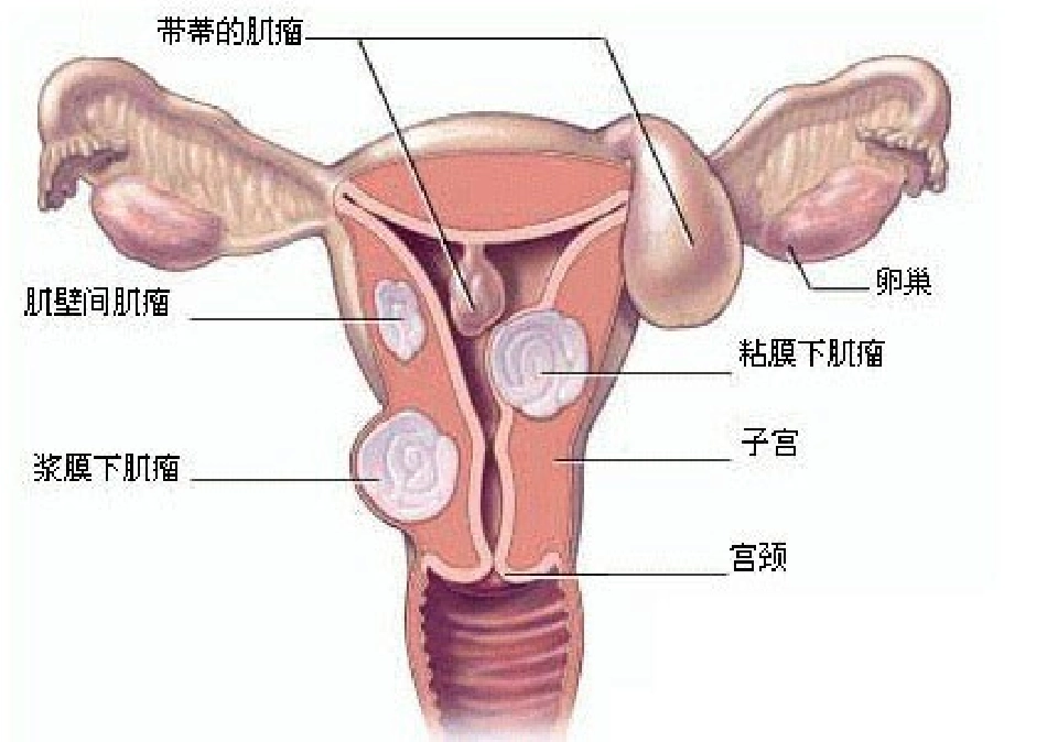 子宫肌瘤病人的护理查房课件_第3页