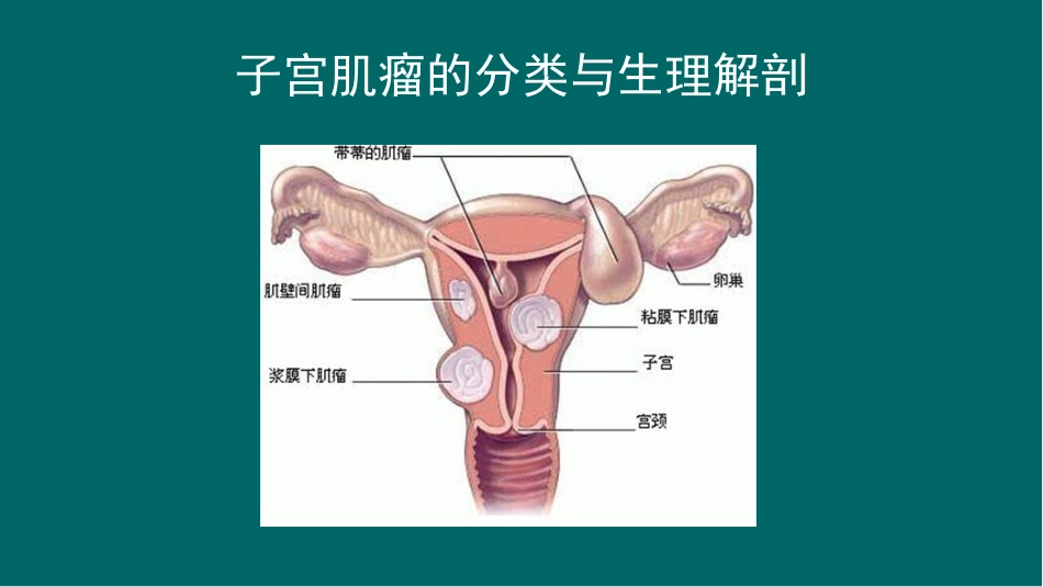 子宫肌瘤的护理查房医学课件_第3页