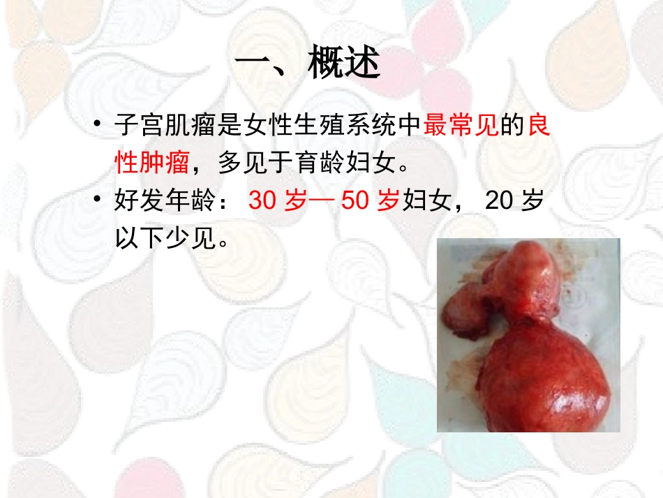 子宫肌瘤患者的护理课件_第2页