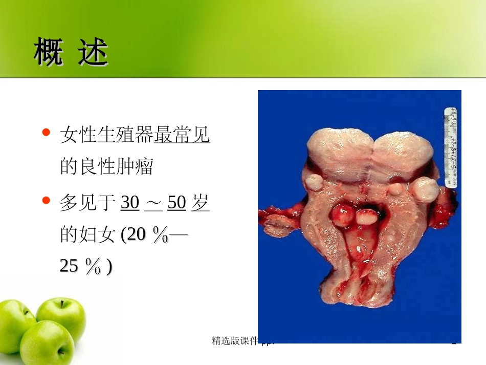 子宫肌瘤讲课_第2页