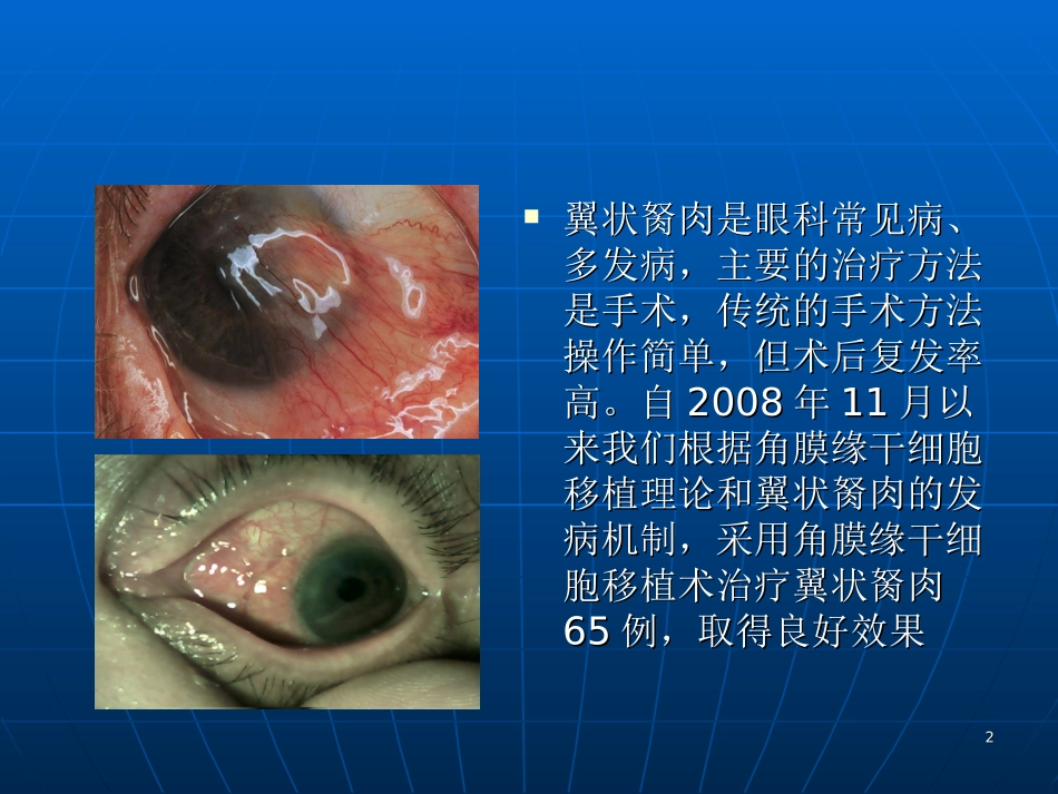 自体角膜缘干细胞课堂_第2页