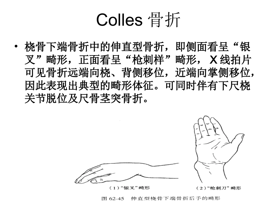 Colles骨折夹板外固定优点详解_第2页