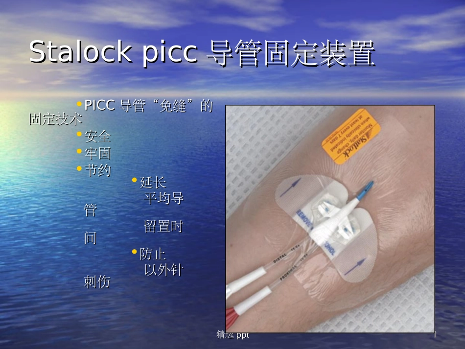 Stalockpicc导管固定装置_第1页