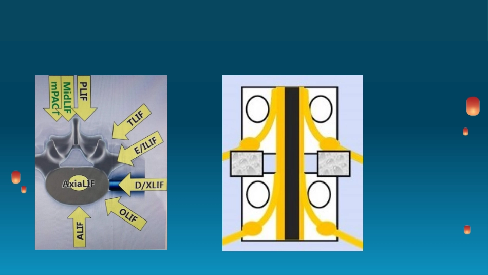 TLIF技术_第3页