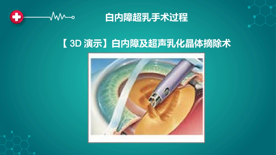 白内障围手术期管理_第2页