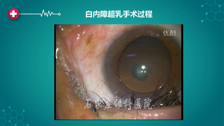 白内障围手术期管理_第3页