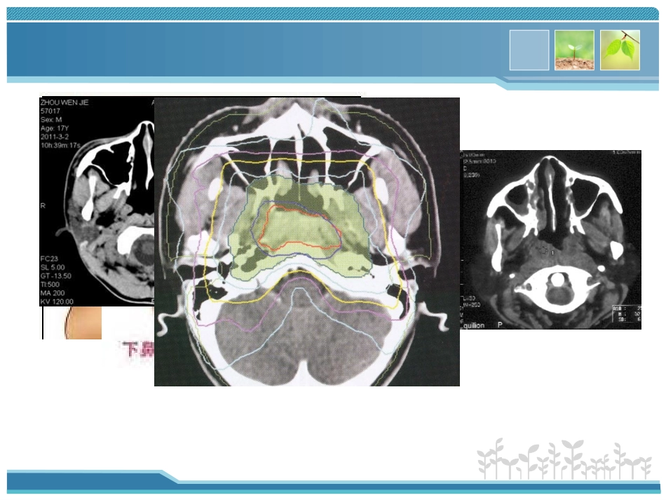 鼻咽癌放射治疗中常见并发症及处置_第2页