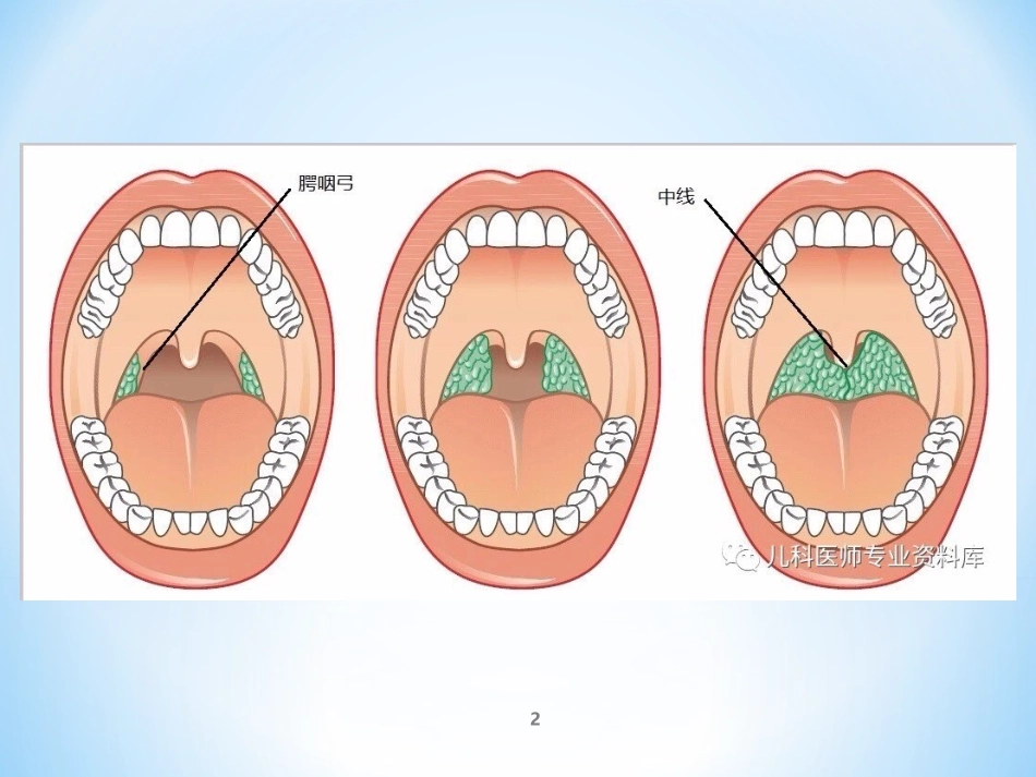 扁桃体切除术课件_第2页