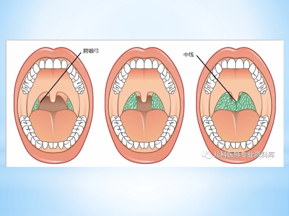 扁桃体摘除术_第2页