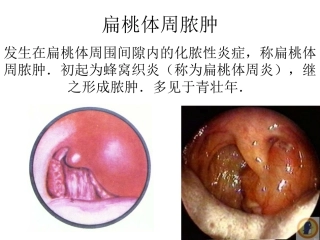 扁桃体周脓肿精