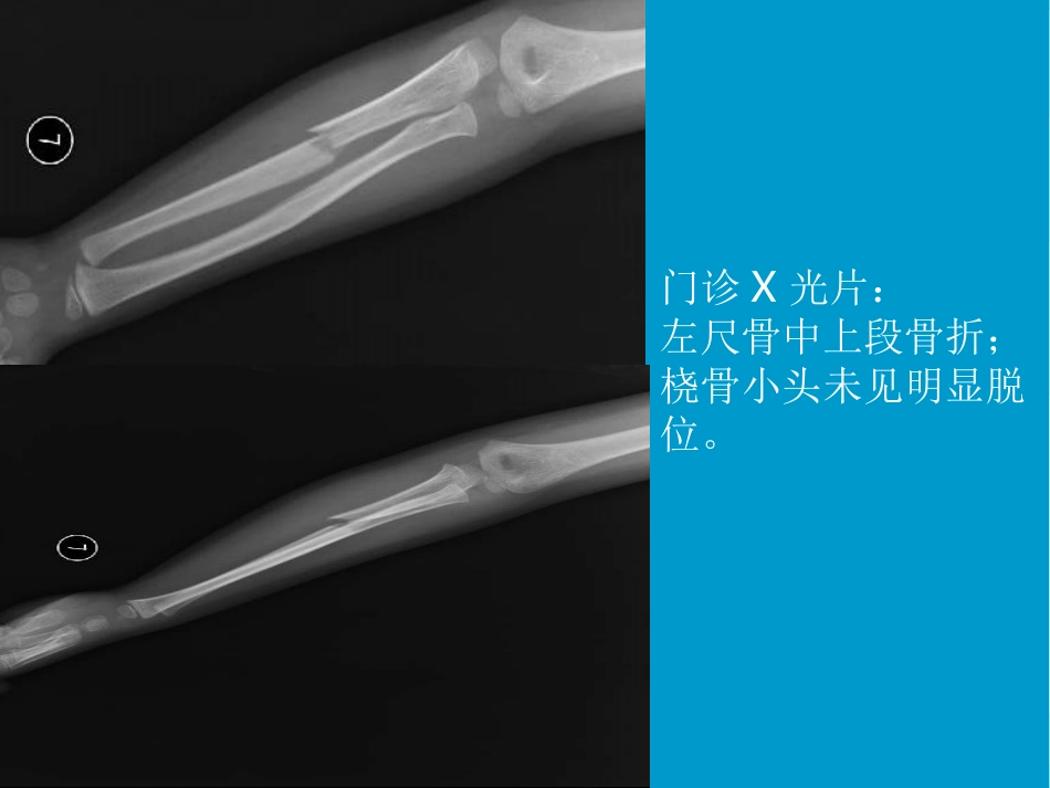 病例讨论孟氏骨折AOCC_第3页