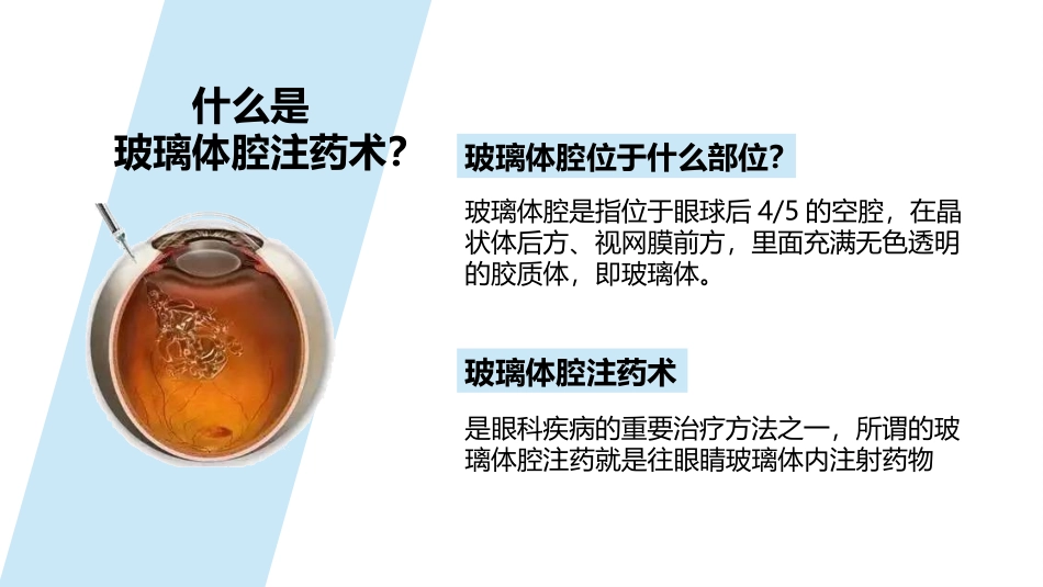 玻璃体腔注药术方法及护理_第2页