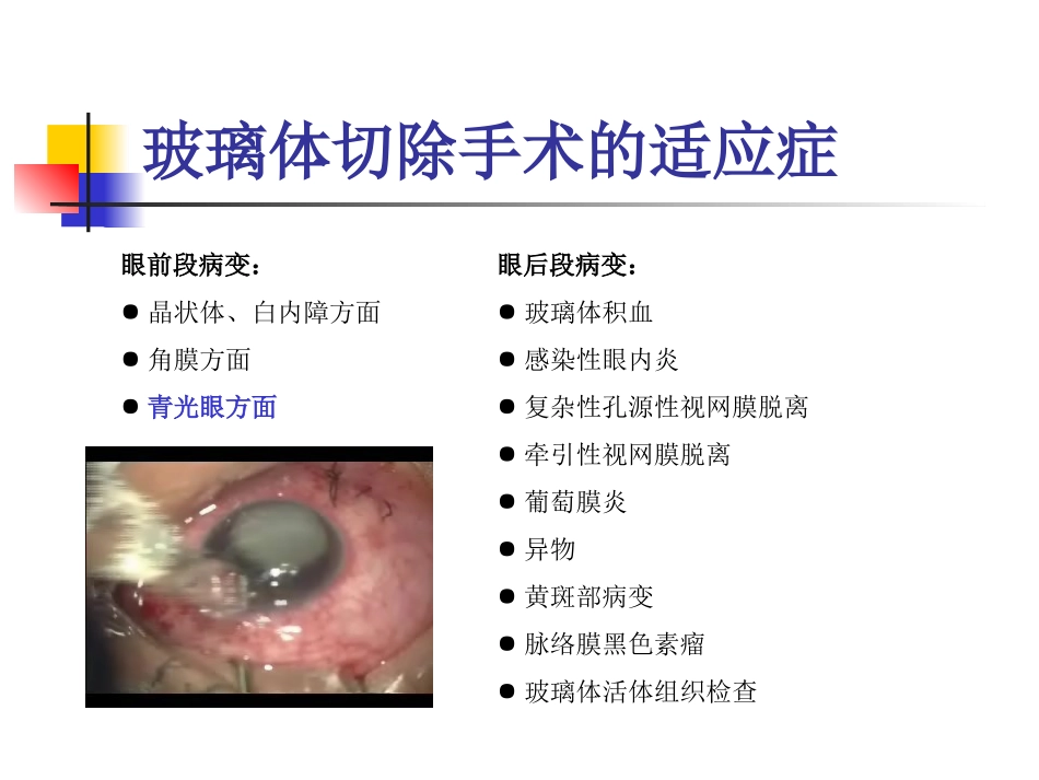 玻璃体切除手术_第3页