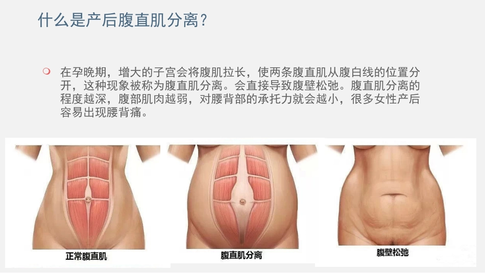 产后腹直肌分离的诊疗_第2页