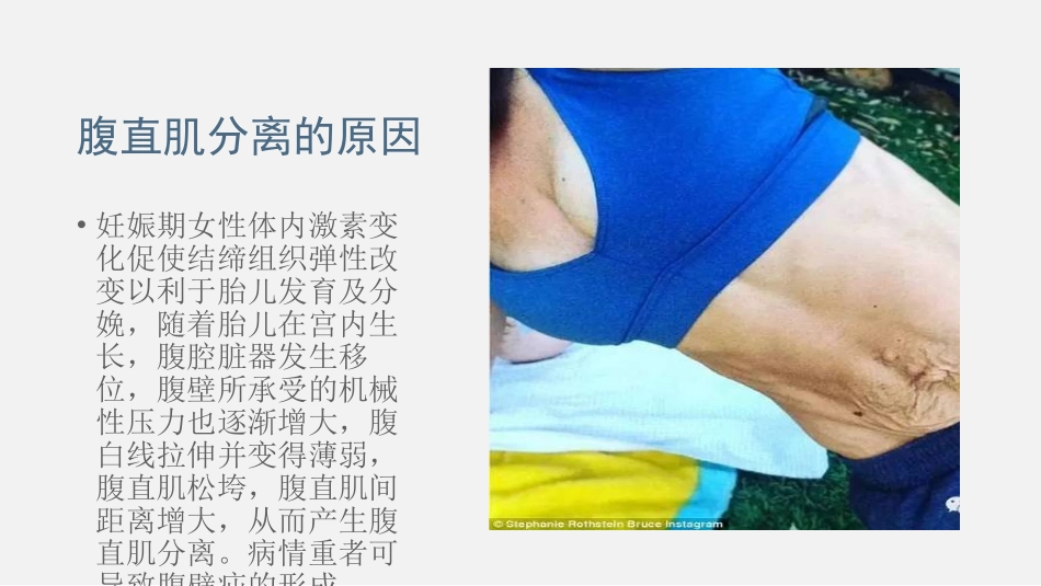 产后腹直肌分离的诊疗_第3页