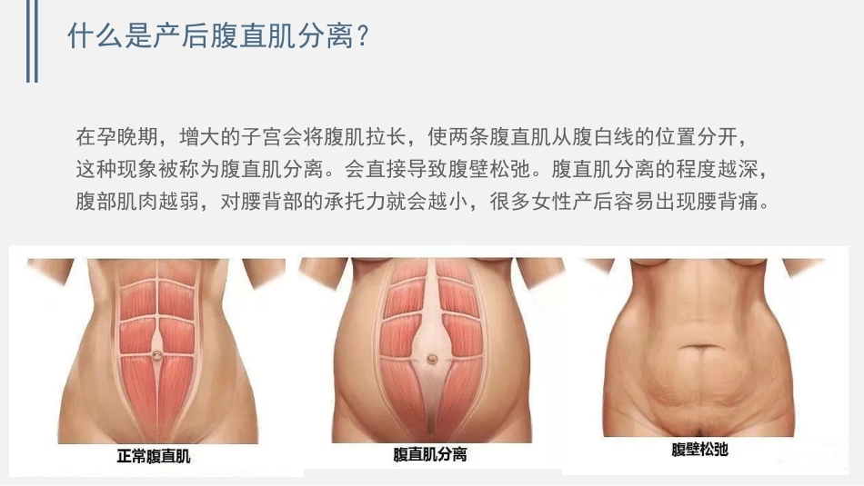 产后腹直肌分离的诊疗和治疗_第2页