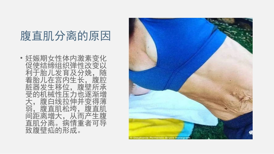 产后腹直肌分离的诊疗和治疗_第3页