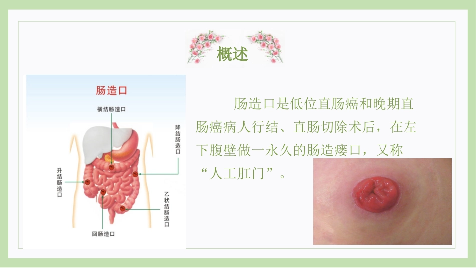 肠造口的更换曾雪维_第3页