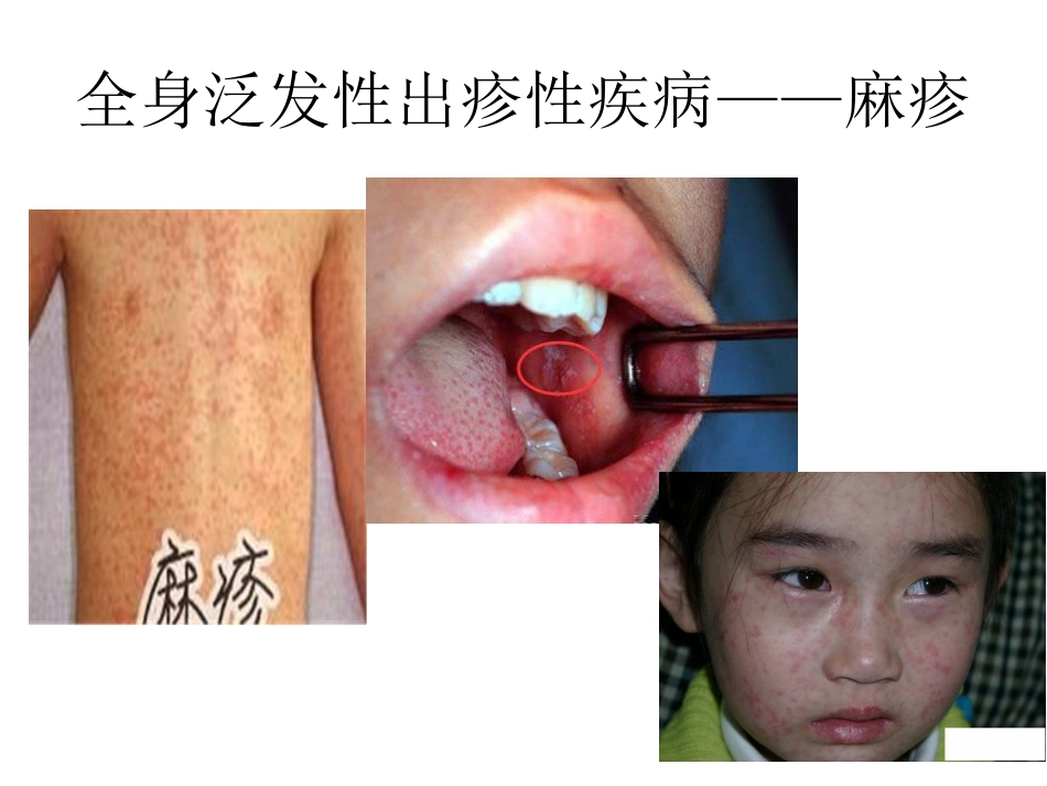 出疹性传染病鉴别_第2页