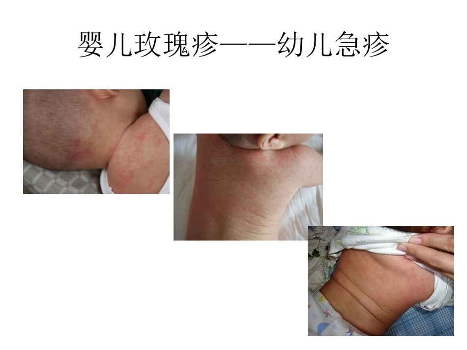 出疹性传染病鉴别_第3页