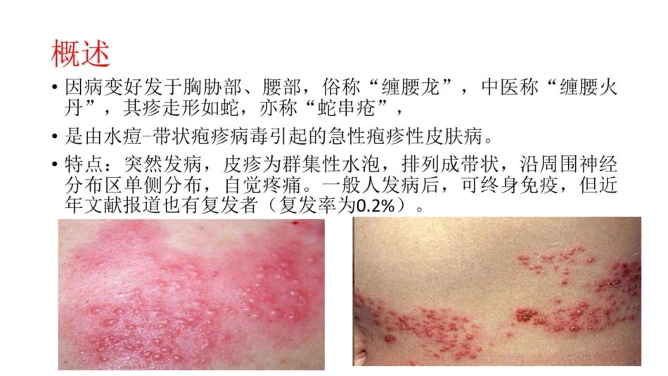 带状疱疹的针灸治疗精品_第2页