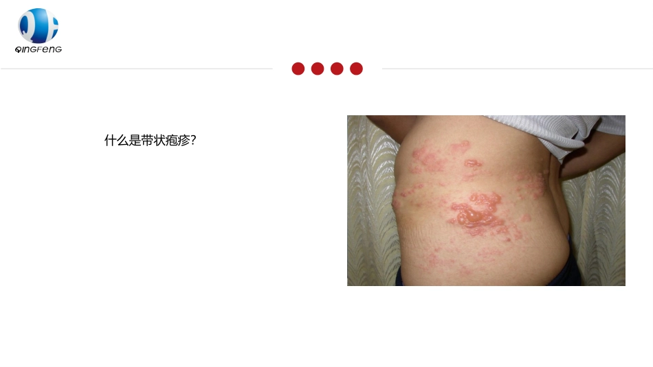 带状疱疹简介_第2页