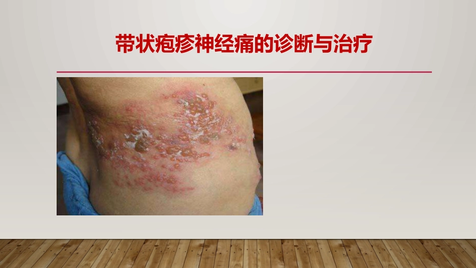 带状疱疹神经痛的诊疗和治疗_第1页