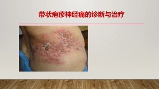带状疱疹神经痛的诊疗和治疗